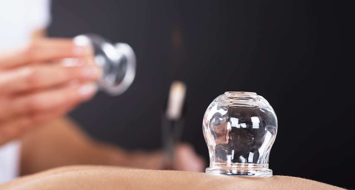 Traditional Flame Cupping | On-Campus Short Course