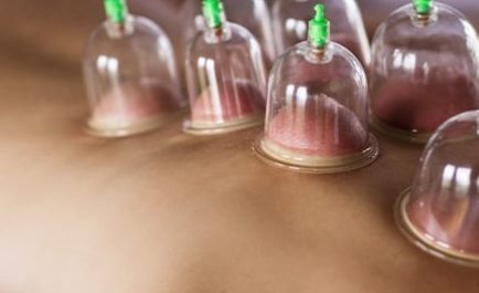 MyofascialCuppingBox MyofascialCuppingBox