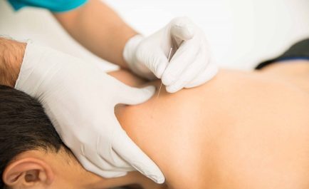 Dry Needling Dry Needling